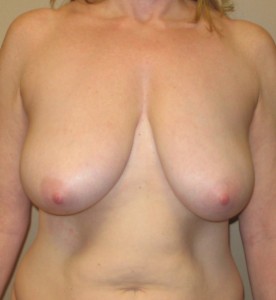 Breast Reductiion Before