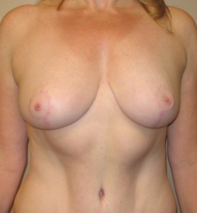 Breast Reduction After