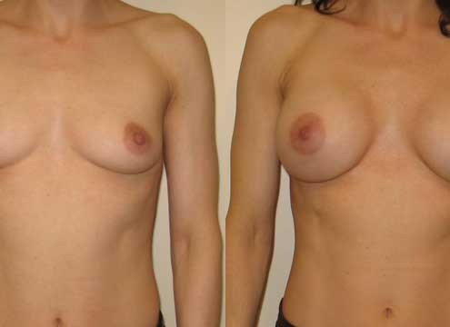 Breast Augmentation Before and After Photos