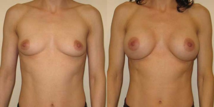 Breast Augmentation Before and After Photos