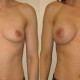 Breast Augmentation Before and After Photos