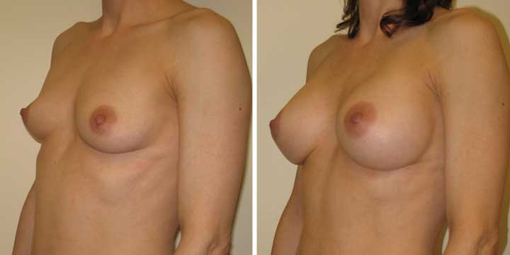 Breast Augmentation Surgery Before and After Photos