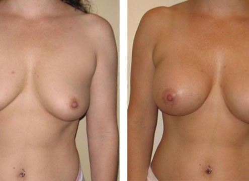 Breast Augmentation post surgery photos