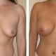 Breast Augmentation post surgery photos