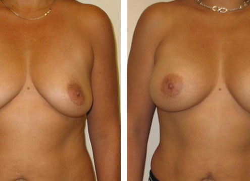 Before and After Pictures of Breast Augmentation Surgeryger Breast with Augmentation Surgery