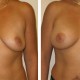 Before and After Pictures of Breast Augmentation Surgeryger Breast with Augmentation Surgery
