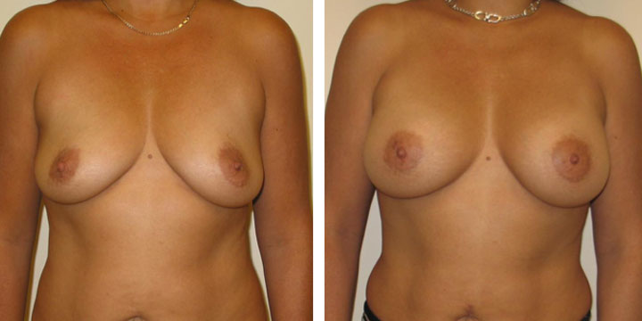 Before and After Pictures of Breast Augmentation Surgery