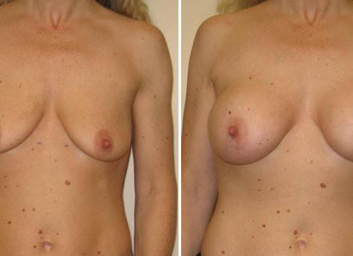 Image of Breast Augmentation Surgery