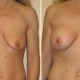 Image of Breast Augmentation Surgery