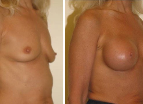 Pre and post surgery Breast Augmentation photos