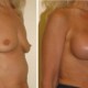 Pre and post surgery Breast Augmentation photos