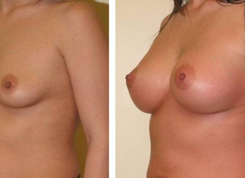 Breast Implants before and after photos