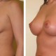 Breast Implants before and after photos