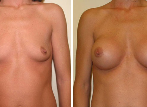 Breast Augmentation before and after photos