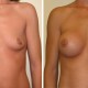 Breast Augmentation before and after photos