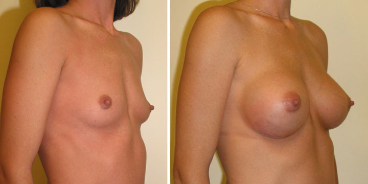 Breast Augmentation before and after pictures