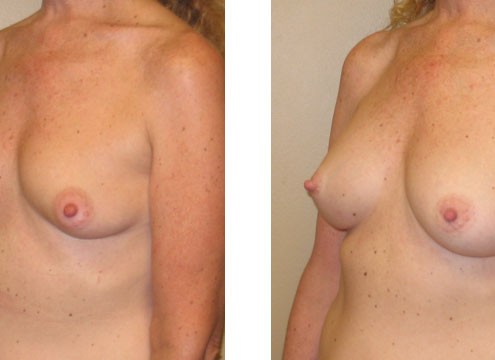 Breast Augmentation before and after images