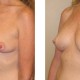 Breast Augmentation before and after images