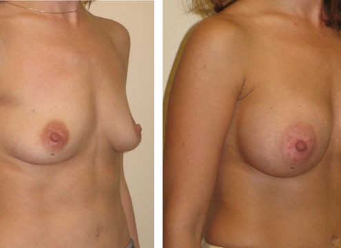 Breast Augmentation Before and After Results