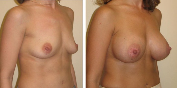 Breast Augmentation Before and After Results