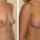 Breast Augmentation Before and After Results