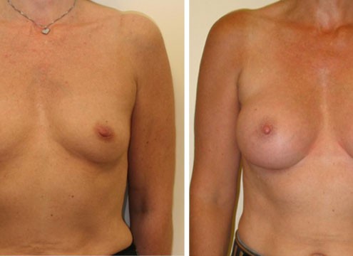 Before and after Breast Augmentation images