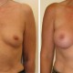 Before and after Breast Augmentation images