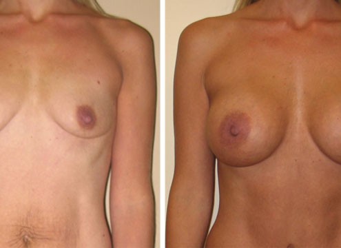 Breast Augmentation Before and After Comparison