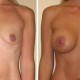 Breast Augmentation Before and After Comparison