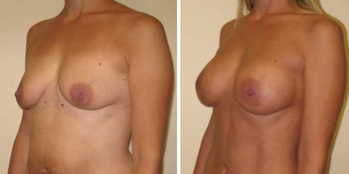 Breast Augmentation Before and After Comparison