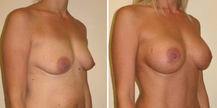 Breast Augmentation Before and After Comparison