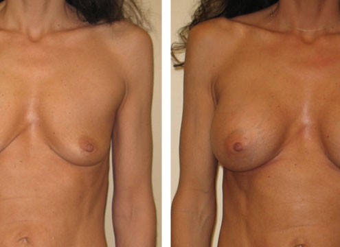 Before & After Photos of Breast Augmentation