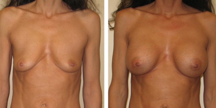 Before & After Photos of Breast Augmentation