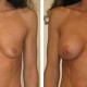 Before & After Photos of Breast Augmentation