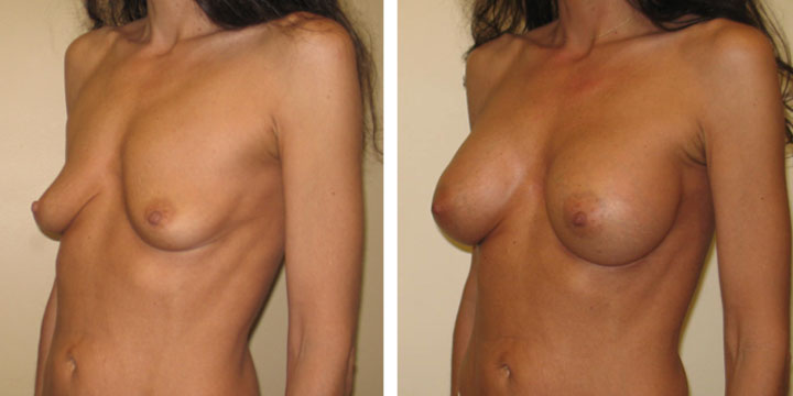 Before & After Photos of Breast Augmentation