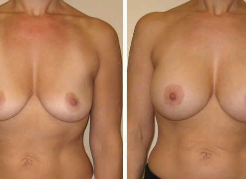 Photo of Breast Augmentation