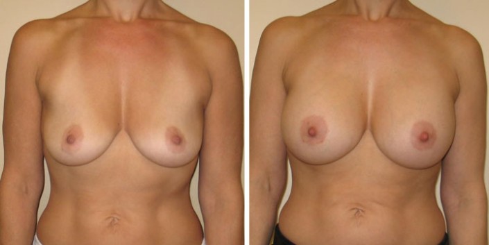 Photo of Breast Augmentation