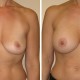 Photo of Breast Augmentation