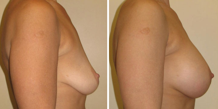 Photo of Breast Augmentation