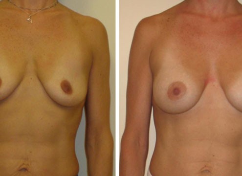 Breast Augmentation Photos Before and After