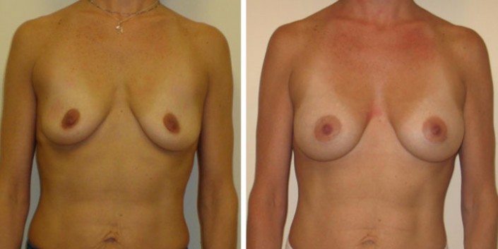 Breast Augmentation Photos Before and After