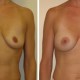 Breast Augmentation Photos Before and After