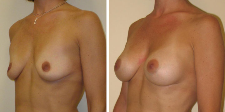 Breast Augmentation Photos Before and After