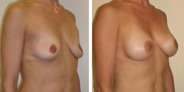 Breast Augmentation Photos Before and After