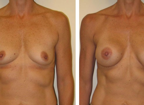 Natural looking Breast Augmentation