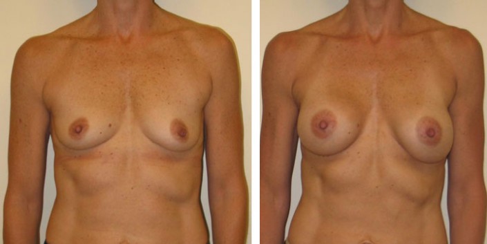 Natural looking Breast Augmentation