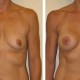 Natural looking Breast Augmentation