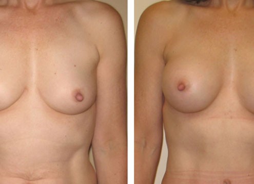 Breast Augmentation after Breast Feeding