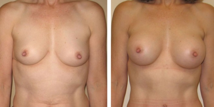 Breast Augmentation after Breast Feeding