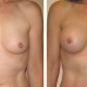 Breast Augmentation after Breast Feeding